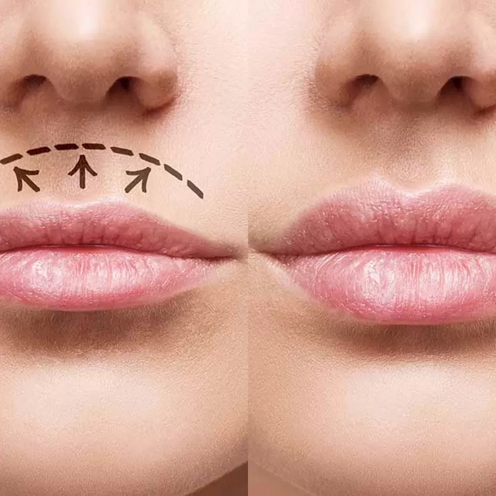 Lip Lift